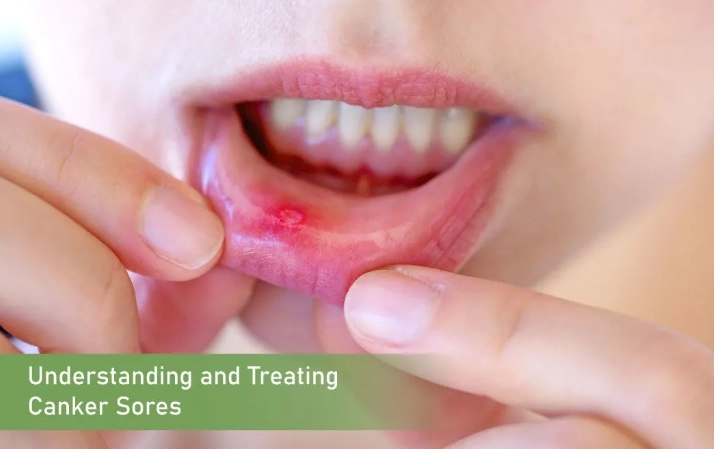 how to get rid of canker sores how to get rid of canker sores