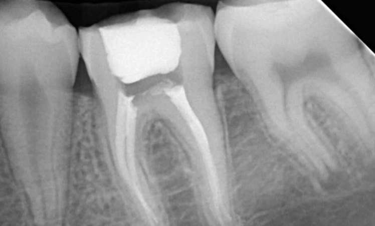 RCT molar teeth