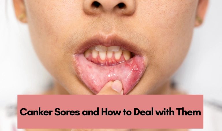 recurrent canker sores recurrent canker sores