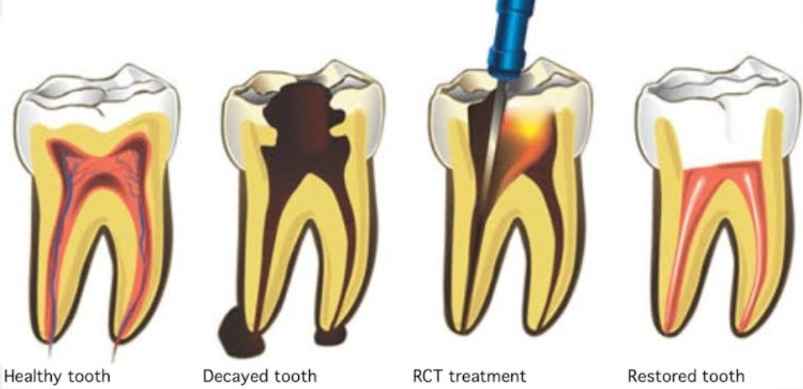 RCT molar teeth