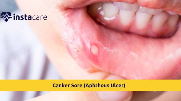 canker sores causes canker sores causes