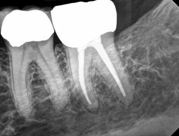 molar tooth pain