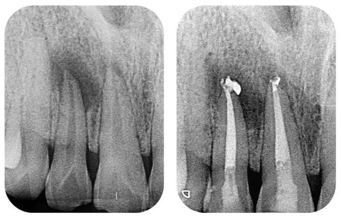 root canal on molar