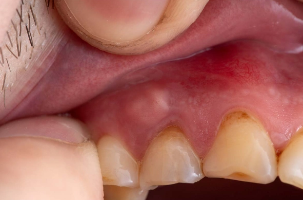 tooth infection symptoms