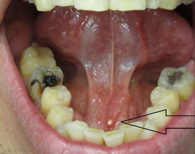 tonsil stones removal tonsil stones removal
