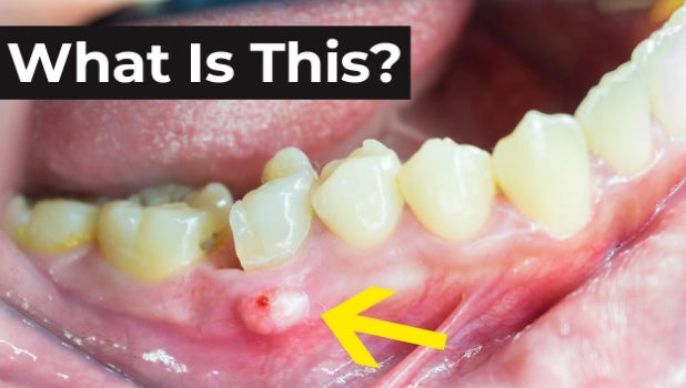 how to treat an infected tooth at home