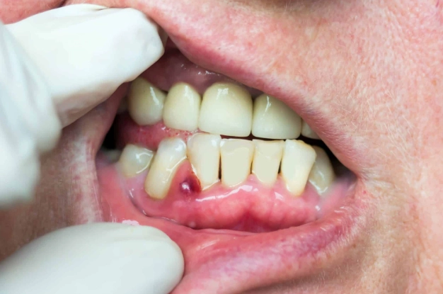 abscessed tooth treatment