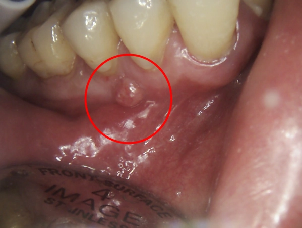 abscessed tooth treatment