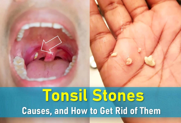 tonsil stones symptoms tonsil stones symptoms