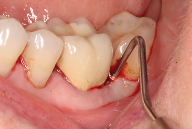 tooth infection symptoms