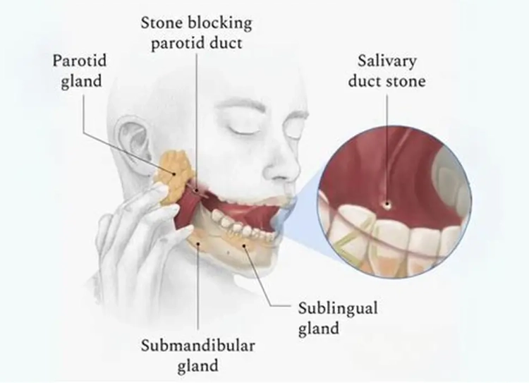 tonsil stones symptoms tonsil stones symptoms