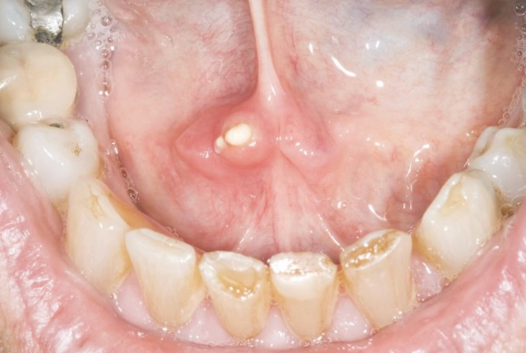 tonsil stones removal tonsil stones removal