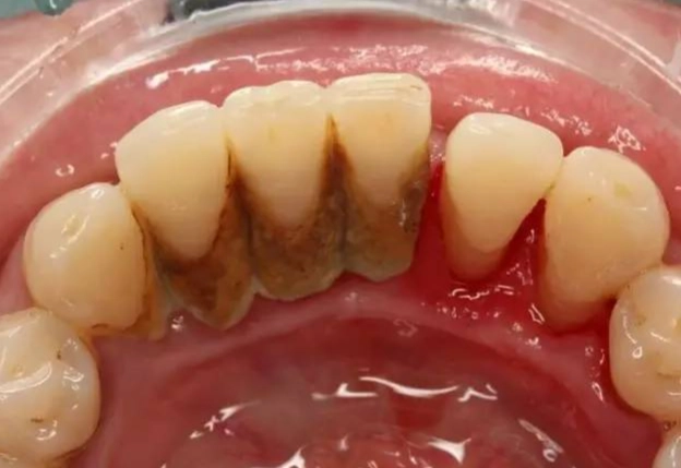 what are tonsil stones what are tonsil stones