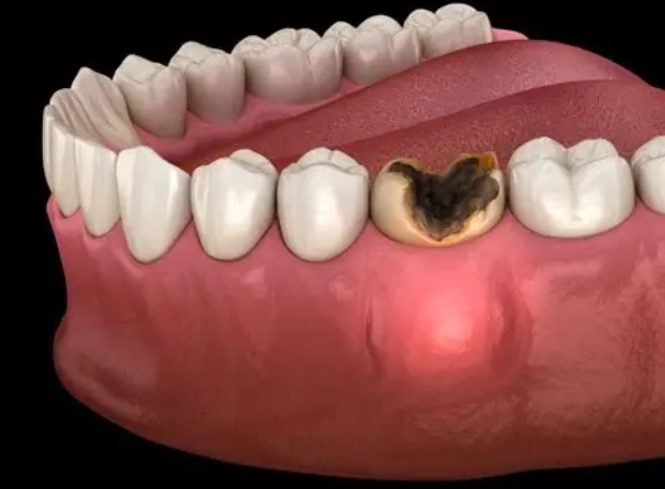 tooth infection symptoms