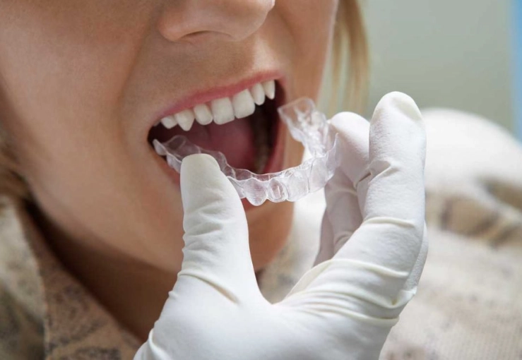 teeth grinding mouth guard