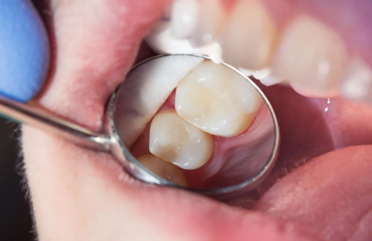 jaw pain 1 week after filling