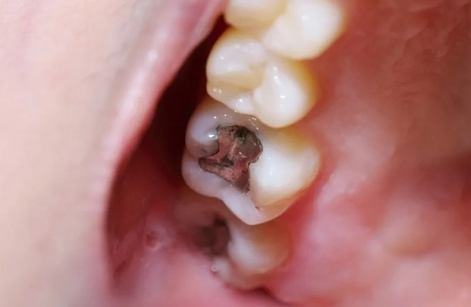 tooth filling pain weeks later