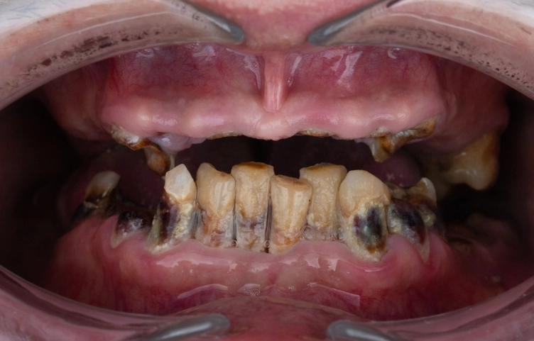 how long for tooth infection to abscess