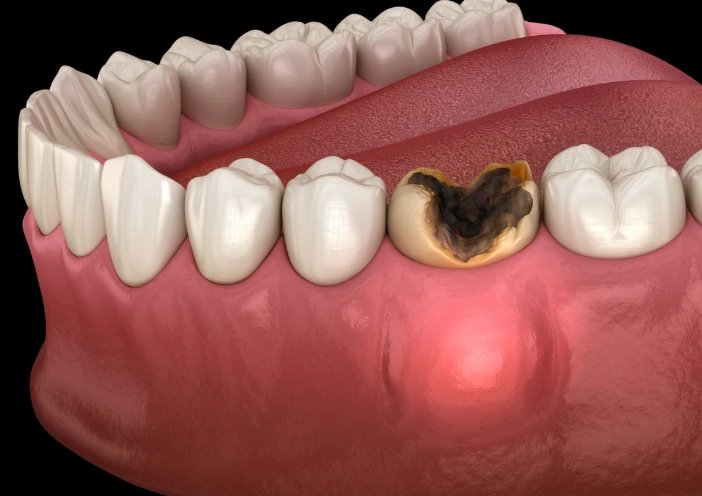 tooth abscess timeline
