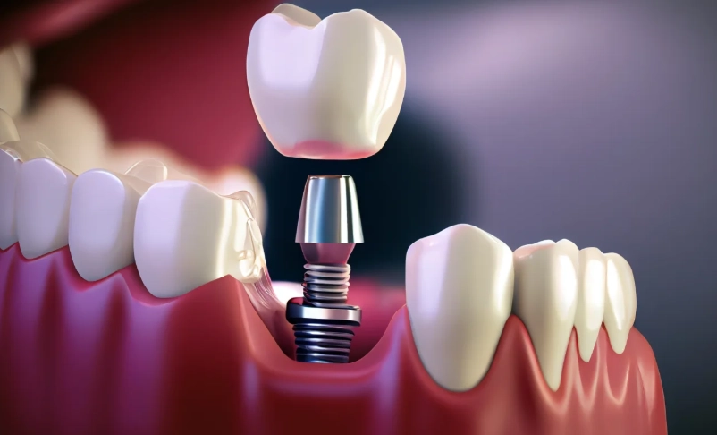 full mouth dental implants cost