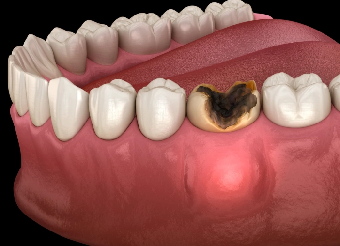 dental abscess treatment