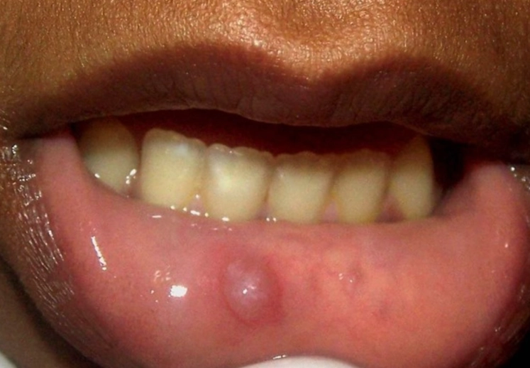 bump on roof of mouth
