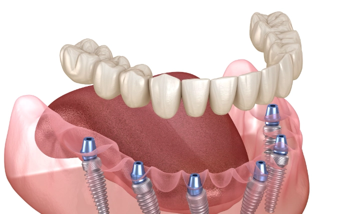 full mouth dental implants cost