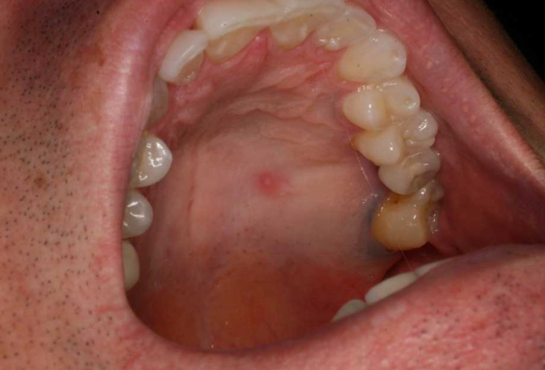 painless lump in mouth