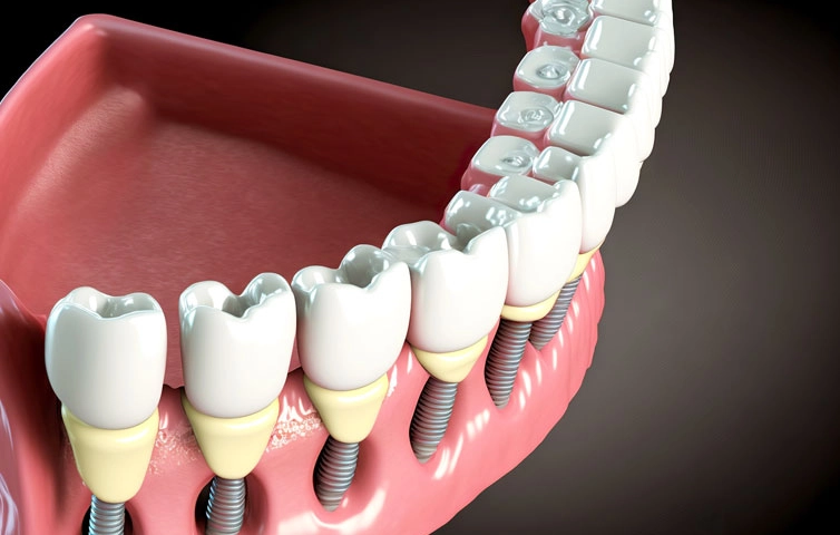 full mouth dental implants pros and cons