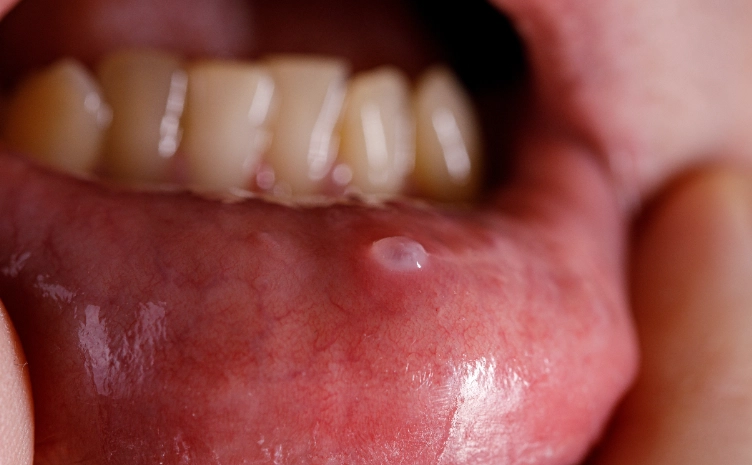 pea sized lump in mouth