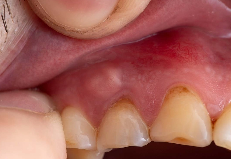 how long for tooth infection to abscess