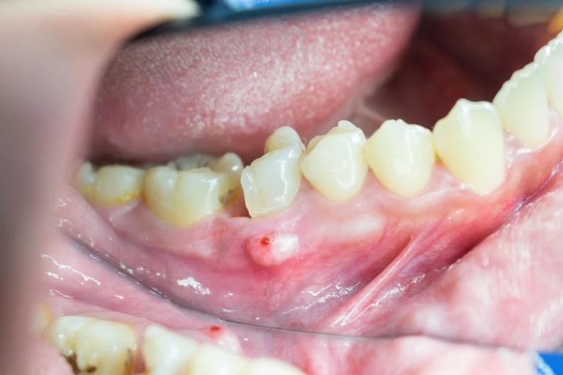 tooth abscess causes