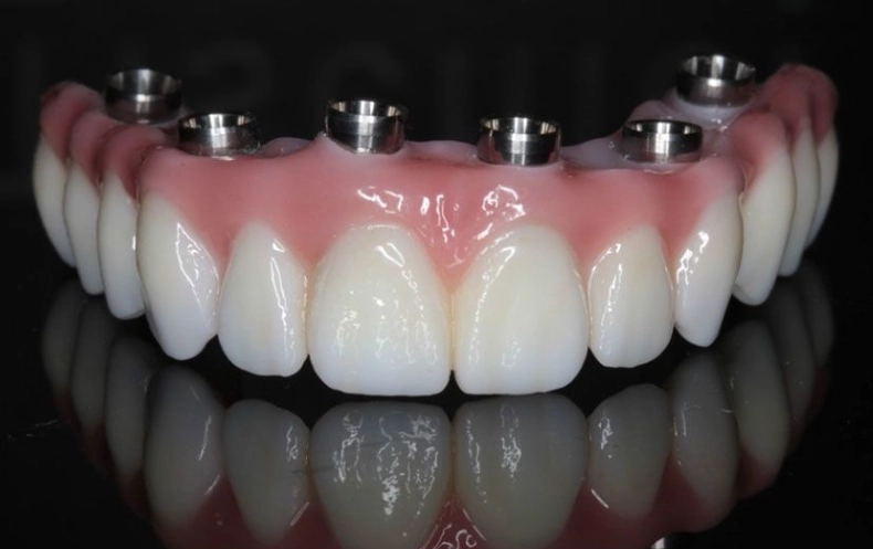 are dental implants worth the money