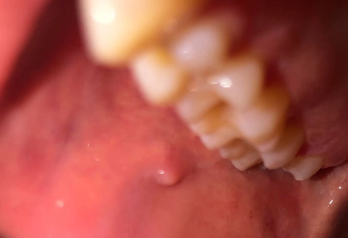 mouth lump causes