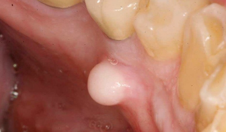 bump on roof of mouth