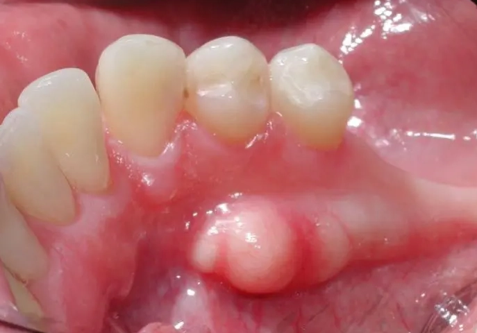 painless lump in mouth
