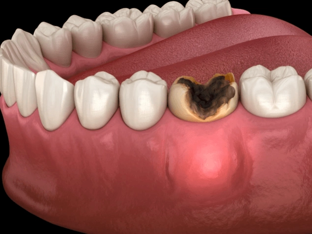 what causes an abscess
