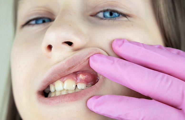 dental abscess treatment