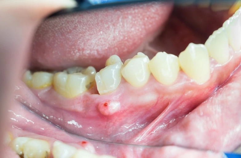 tooth abscess home remedy