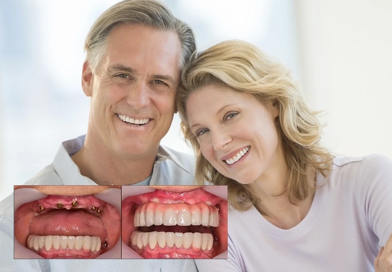 full mouth dental implants cost