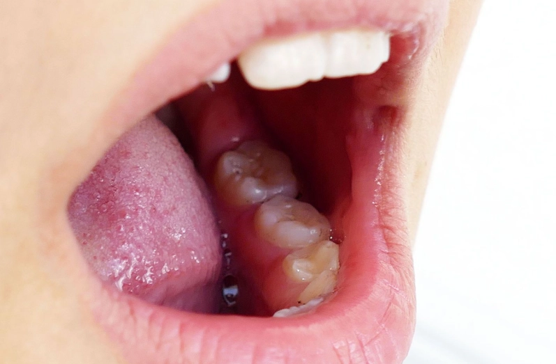 pea sized lump in mouth