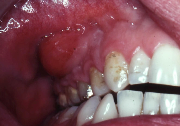 tooth infection symptoms
