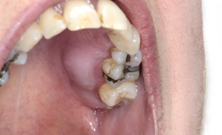 what causes an abscess