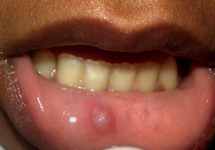 mouth lump causes