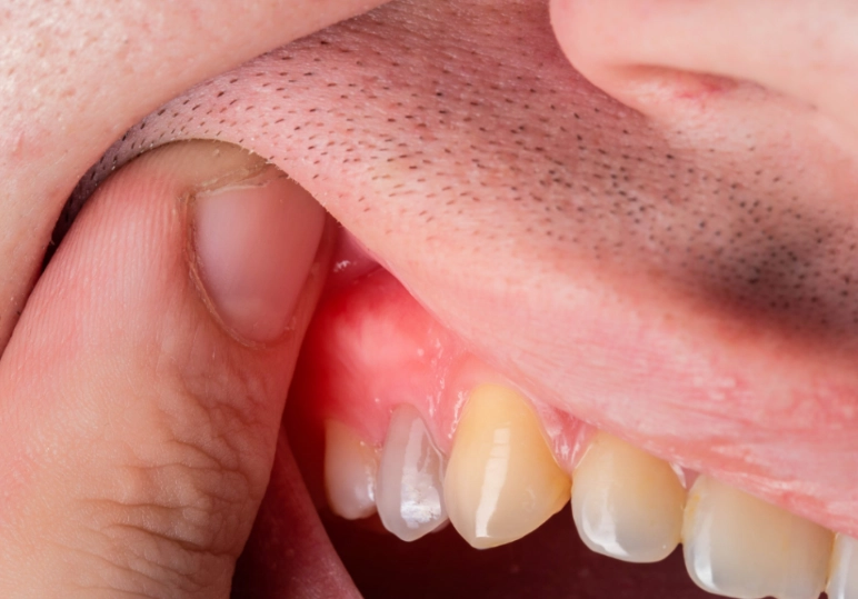 dental abscess symptoms