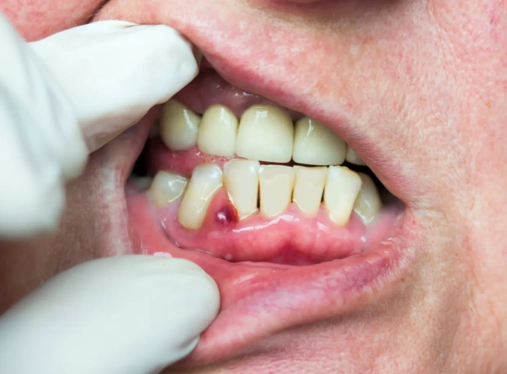 symptoms of dental abscess