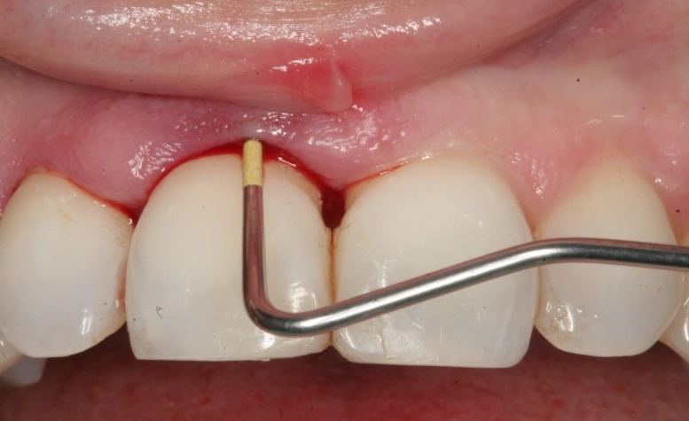 dental abscess treatment