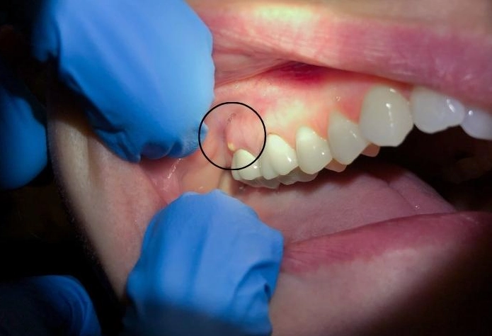 tooth abscess timeline