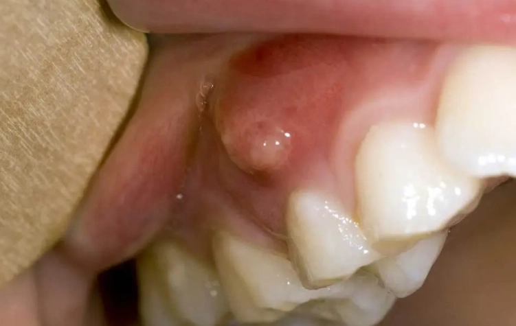painless lump in mouth
