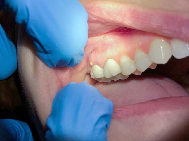 tooth infection symptoms